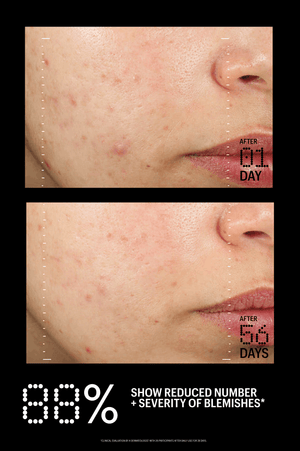 Azelaic & Kojic Advanced Clarifying Serum
