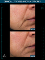 Allies lifting serum before after